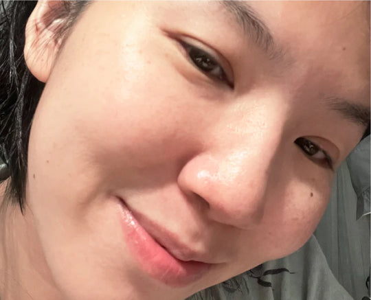 Xiao Juan: Sensitive skin, dark spots, fine lines