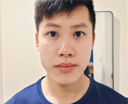 Cheng Xun:Acne, blackheads, and enlarged pores